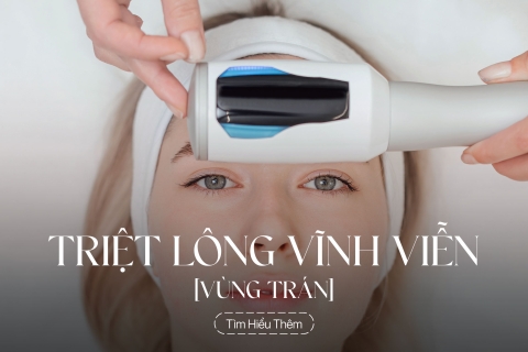 Triệt lông vùng trán vĩnh viễn